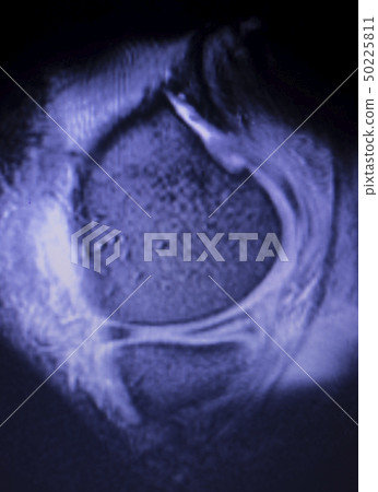 MRI knee meniscus tear scan MRI knee meniscus tear scan 50225811