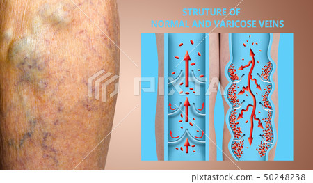 Varicose veins on a female senior legs. The 50248238