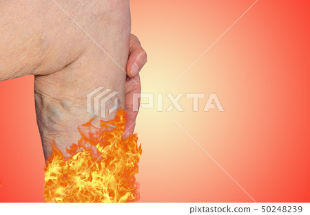 Varicose veins on a legs of old woman on pastel. 50248239