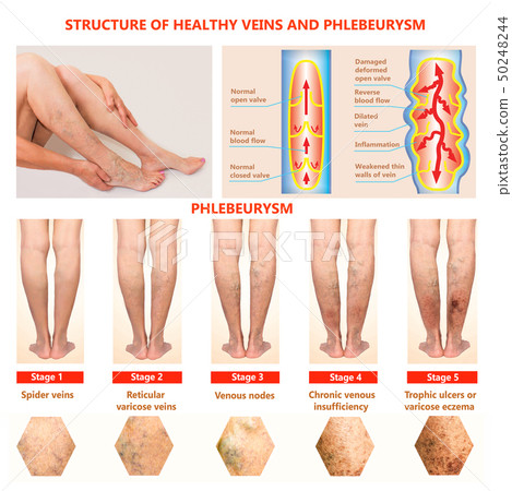 Thrombophlebitis. Deep Vein Thrombosis. Varicose Thrombophlebitis. Deep Vein Thrombosis. Varicose 50248244