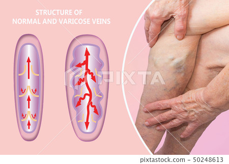 Varicose veins on a female senior legs. The 50248613