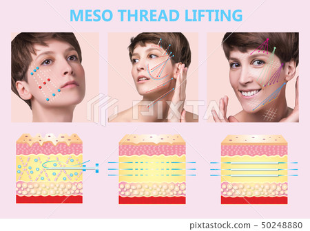 Meso thread Lift. Young female with clean fresh 50248880