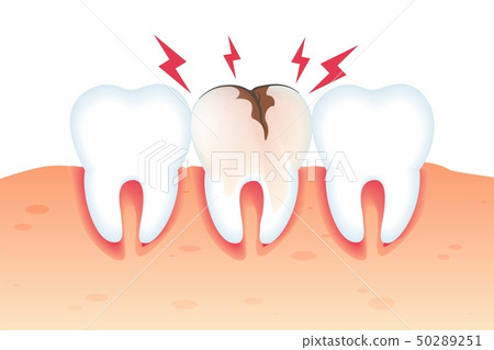 Pain in Broken Tooth Illustration Realistic 3d. Pain in Broken Tooth Illustration Realistic 3d. 50289251