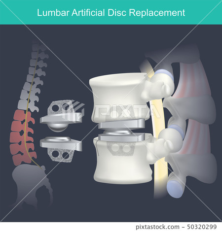 Lumbar Artificial Disc Replacement. Lumbar Artificial Disc Replacement. 50320299