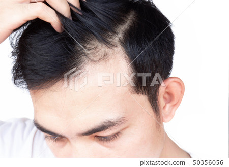 Young man serious hair loss problem for health  50356056