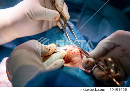 Rhinoplasty close-up of nose surgery. The hands of the surgeon working tools in white gloves 50491666