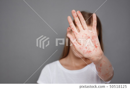Stop Measles. Girl With Virus Closing Face Over Grey Background Stop Measles. Girl With Virus Closing Face Over Grey Background 50518125
