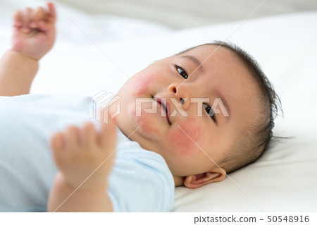 Baby has an allergic reaction to the face Baby has an allergic reaction to the face 50548916