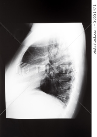 side view of human thorax with lungs 50551471