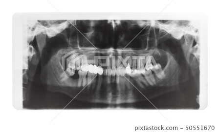 film with X-ray image of jaws with dental pins 50551670