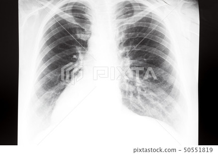 human thorax with lungs on X-ray image 50551819