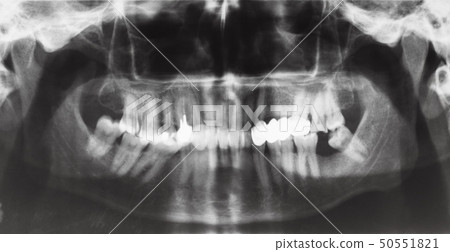 human jaws with dental crown and pins in teeth 50551821