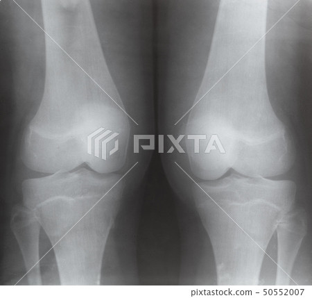 view of two human knee joints on X-ray image view of two human knee joints on X-ray image 50552007