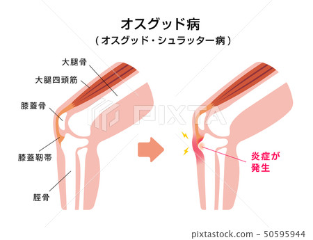 Osgood's disease (Osgood Schlatter's disease) illustrated illustration 50595944
