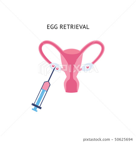 Female egg retrieval for fertilization Female egg retrieval for fertilization 50625694