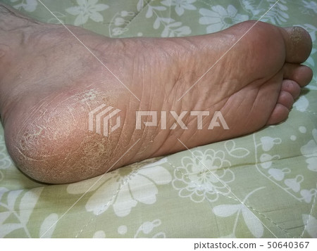 腳底（腳後跟） 50640367