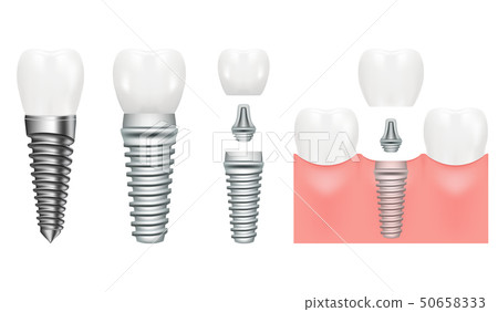 Realistic dental implant structure with all parts crown, abutment, screw. Dentistry. Implantation of 50658333