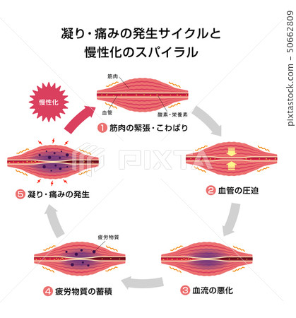 Shoulder stiffness (stiffness) · Pain occurrence cycle and chronicification process Illustration 50662809