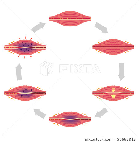 Stiff neck (stiffness) / Pain generation process (6 steps / circle) Illustration / Without text Stiff neck (stiffness) / Pain generation process (6 steps / circle) Illustration / Without text 50662812