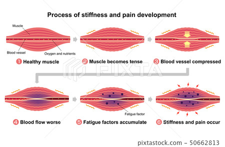 Stiff neck (stiffness) / Pain generation process (6 steps) Illustration / English Stiff neck (stiffness) / Pain generation process (6 steps) Illustration / English 50662813