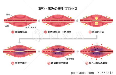 Stiff neck (stiffness) · Pain generation process (6 steps) Illustration Stiff neck (stiffness) · Pain generation process (6 steps) Illustration 50662818