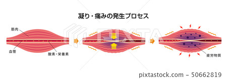 Illustration of the process of stiff shoulder (stiffness) and pain 50662819