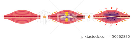 Shoulder stiffness (toughness) · Pain generation process Illustration / without characters Shoulder stiffness (toughness) · Pain generation process Illustration / without characters 50662820