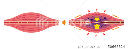 Stiff shoulder (stiffness) · cause of pain caused illustration / no letter 50662824