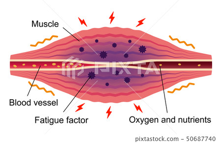 Illustration of stiff / painless muscle / Shoulder stiff, stiff / pain 50687740