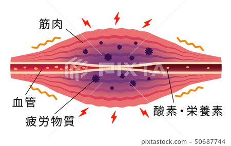 Stiffness / Pain causing muscle (English) / Stiff shoulder / Stiffness / Pain occurrence illustration Stiffness / Pain causing muscle (English) / Stiff shoulder / Stiffness / Pain occurrence illustration 50687744