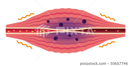 Muscle that fatigue material has generated (no character) / Shoulder stiff, stiff, pain outbreak illustration 50687746