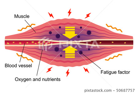 Stiffness / Pain causing muscle (English) / Stiff neck / Stiffness / Pain occurrence illustration Stiffness / Pain causing muscle (English) / Stiff neck / Stiffness / Pain occurrence illustration 50687757