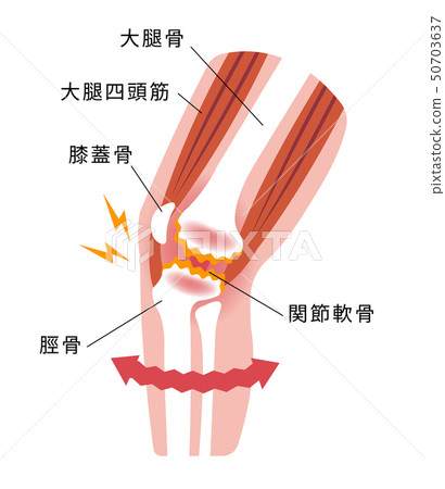 Mechanism and cause of knee joint pain (degenerative knee arthritis) 50703637