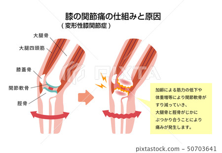 膝關節疼痛的機制和原因 退行性膝關節炎 插圖素材 圖庫