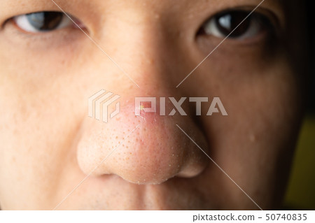 Closed-up many blackhead pimples and acne scars on 50740835