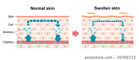Cutaway cross section illustration / Skin with swelling (edema) and normal skin Comparison (English) 50766713