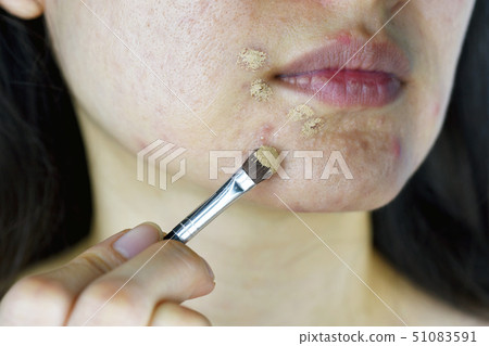 Cosmetics acne, Asian woman applying concealer 51083591