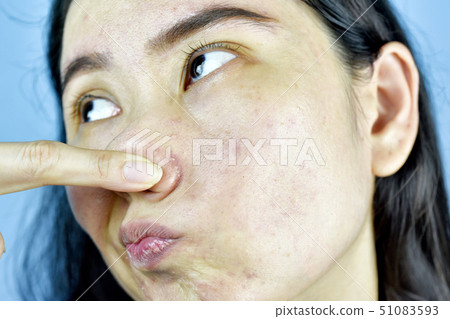 Acne skin problem, Asian woman annoy and bored 51083593