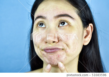 Acne skin problem, Asian woman annoy and bored 51083596