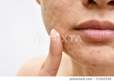 Acne and face skin problem, Woman applying acne 51083598