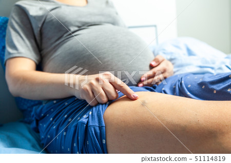 Varicose veins in pregnant women. Woman sits on a bed and points her finger at swollen veins Varicose veins in pregnant women. Woman sits on a bed and points her finger at swollen veins 51114819