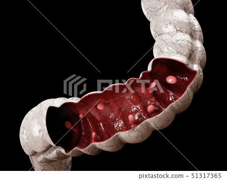 Colon polyps. 3d illustration, Polyp in the intestine. 51317365