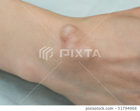 Big cyst (hygroma) 51794908