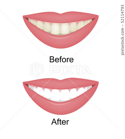 Teeth Whitening Before and After. Vector Illustartion 52114793