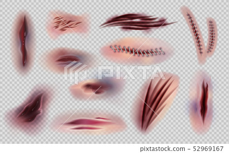 Realistic wounds and stitches. Cut skin and body marks and scratches isolated, bruises and injuries Realistic wounds and stitches. Cut skin and body marks and scratches isolated, bruises and injuries 52969167