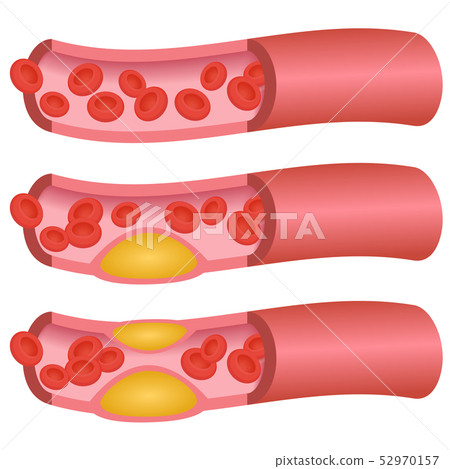Blood vessels (cholesterol) 52970157