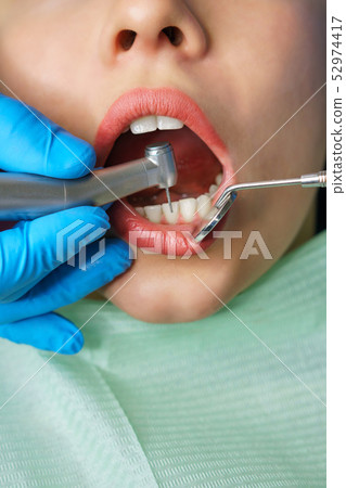 Dentist treats girl's teeth. Dentist treats girl's teeth. 52974417