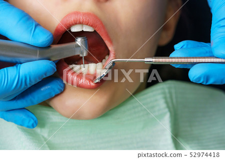 Dentist treats girl's teeth. Dentist treats girl's teeth. 52974418