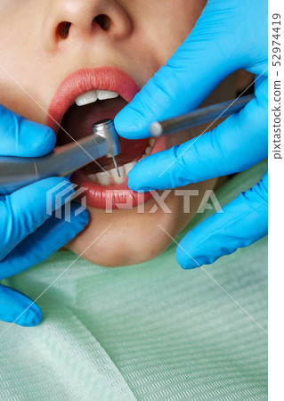 Dentist treats girl's teeth. Dentist treats girl's teeth. 52974419