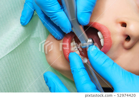 Dentist treats girl's teeth. Dentist treats girl's teeth. 52974420